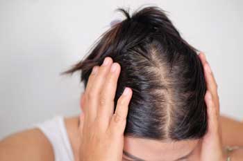 woman-checks-for-hair-loss